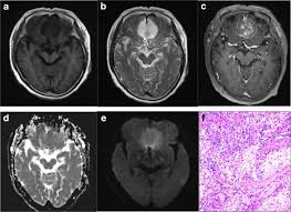 Series 001 — Frontal Lobe Mass (Likely Meningioma) Overview